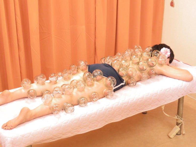 カッピング