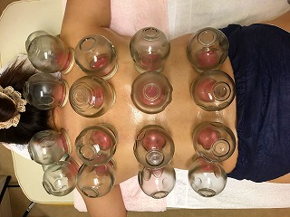 cupping